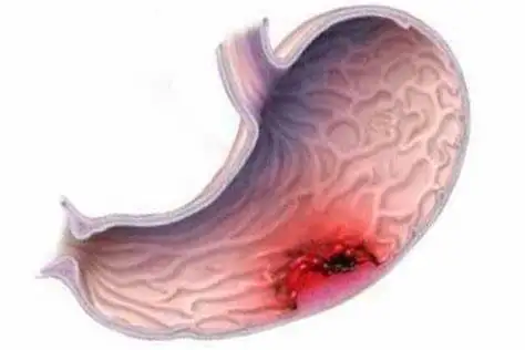 胃部隐痛十年,可能是慢性胃炎在作祟,别忽视它!