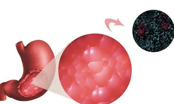 糜烂性胃炎：全面解析及管理指南