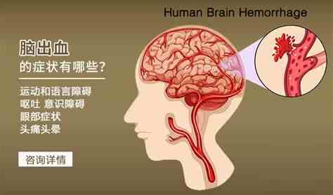 脑出血的分类、诊断与治疗：专业解析与<span style="color: #da4707">临床实践</span>