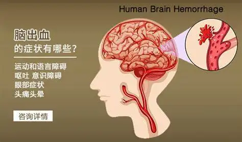 脑出血的分类、诊断与治疗:专业解析与临床实践