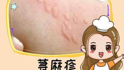 战胜慢性荨麻疹：摆脱瘙痒困扰的指南封面图