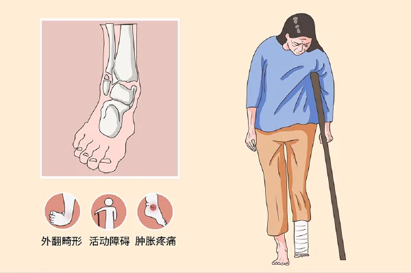 跟骨骨折及其治疗的全攻略——从病理到康复,你必须知道的一切!