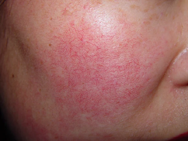 过敏性皮炎—你必须了解的那点事！