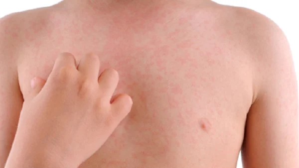 如何应对和预防急性荨麻疹