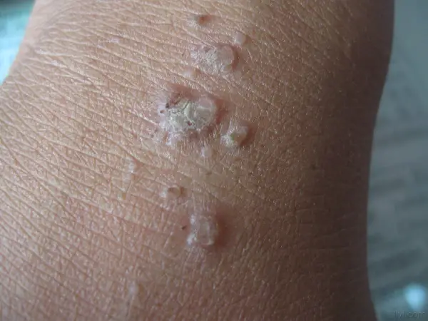 扁平疣：你需要知道的一切！