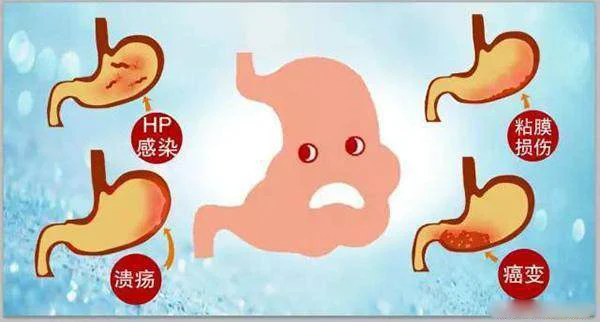 慢性胃炎:全面了解诊断与治疗策略