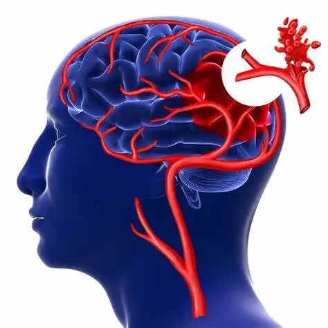 认识脑出血:分类、诊断与治疗