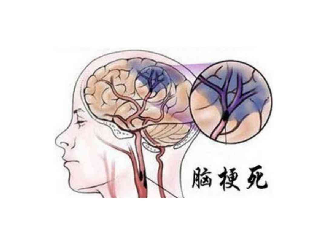 科普，早诊断，早治疗：<span style="color: #da4707">识别</span>和预防<span style="color: #da4707">脑梗死</span>