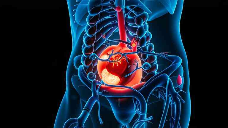 科普，腹主动脉瘤：静悄悄的“生死时速”！你不能忽视的肚中“定时炸弹”封面图